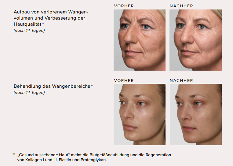 Radiesse Ergebnisse
