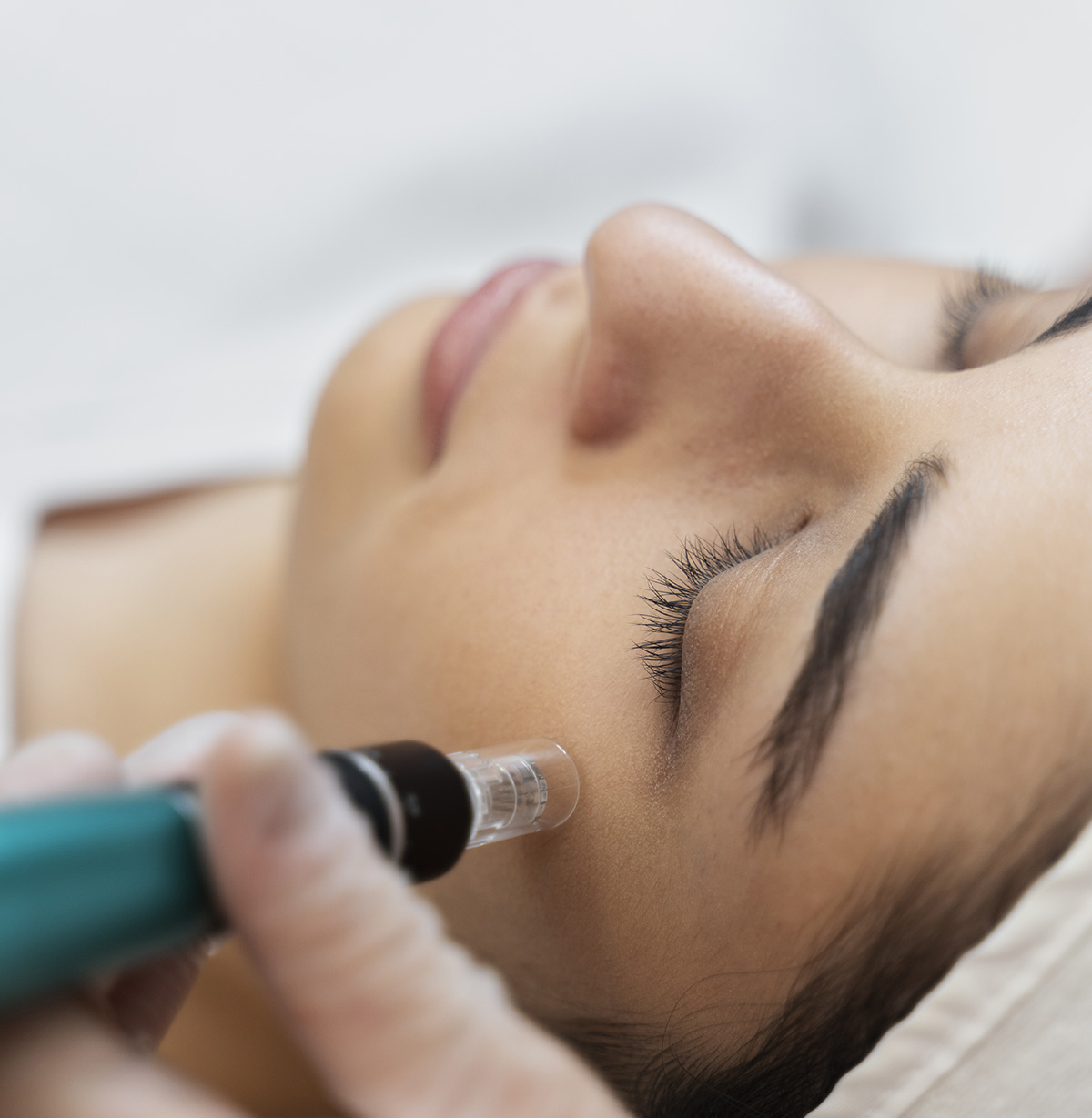 Medizinisches Microneedling in München Schwabing - Natürliche Hautverjüngung mit Dr. med. Sarah Bangert
